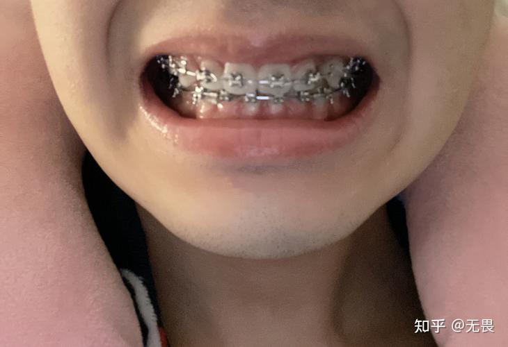 武汉口腔医院矫正牙齿哪家好？效果靠谱吗？-图1