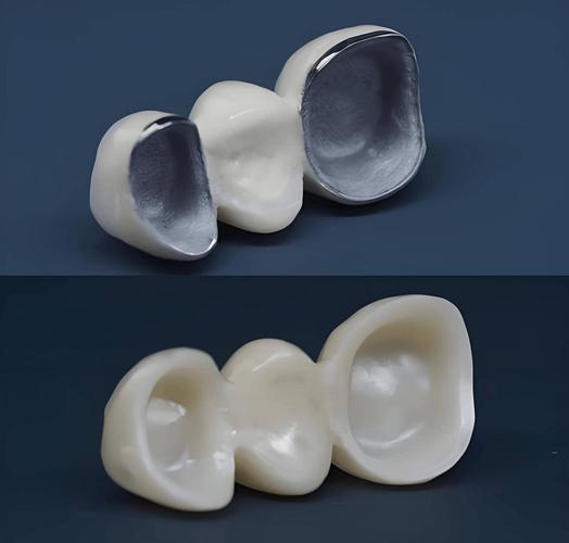 矫正牙齿有烤瓷牙，会影响矫正效果吗？-图3