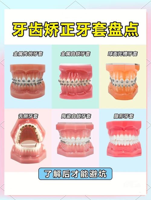 矫正牙齿的材料哪种比较好?-图1 矫正牙齿的材料哪种比较好?-图1