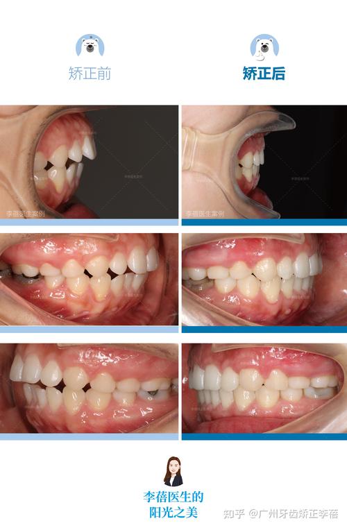 40岁能做牙齿矫正吗？有年龄限制吗？-图3