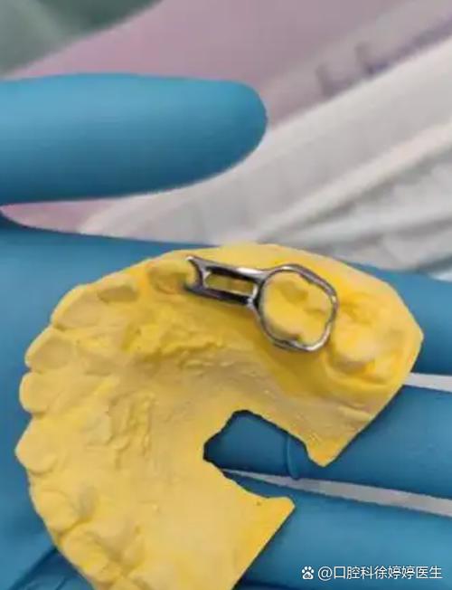 矫正拔牙具体要拔哪些牙齿？-图3