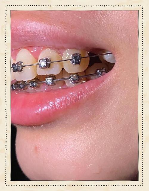 矫正牙齿时，医生为何建议拔牙？-图2