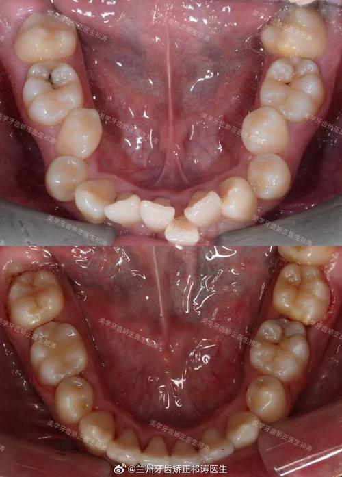 拔牙矫正后牙齿松动？是正常现象还是需警惕？-图2