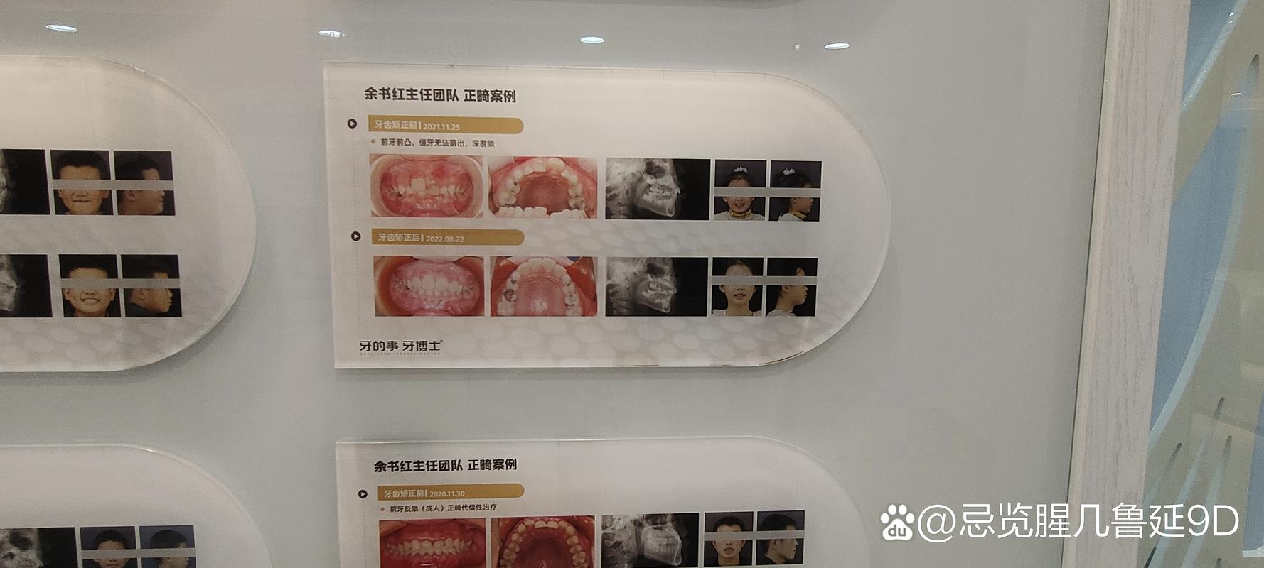 异地矫正牙齿，复诊间隔和交通怎么协调才方便？-图3