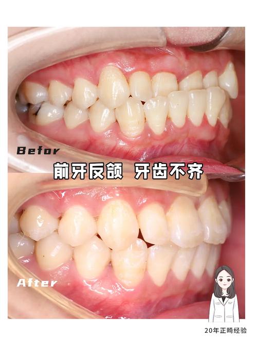 矫正牙齿不拔牙效果图-图1