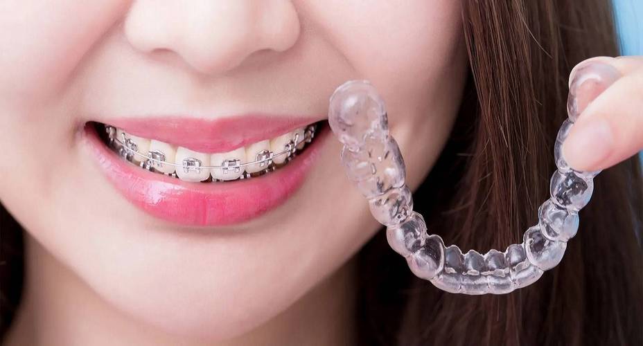 矫正后保持器要戴多久？不戴会反弹吗？-图1