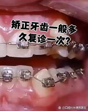 矫正牙齿复诊间隔多久一次合适？-图2