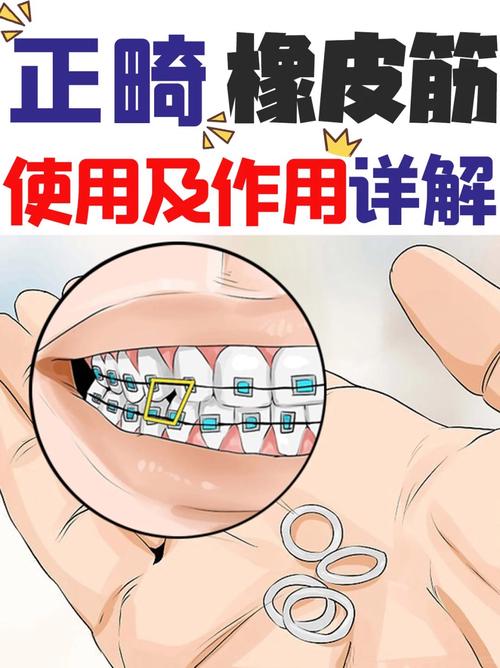 牙齿矫正橡皮筋的作用究竟是什么？-图1