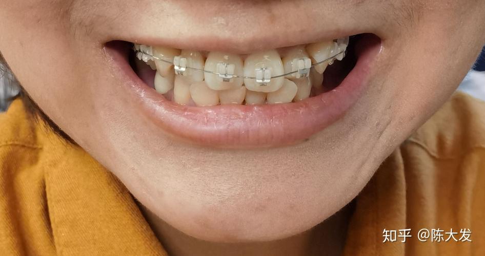 27岁矫正牙齿还来得及吗？年龄不是问题吧？-图3