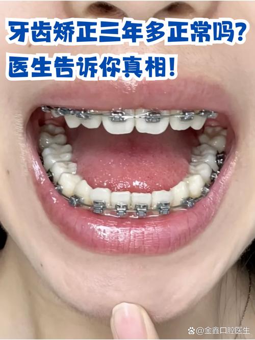 矫正牙齿的过程一般需要多长时间？-图2