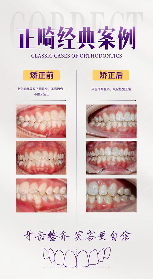 可以不拔牙矫正牙齿吗-图2