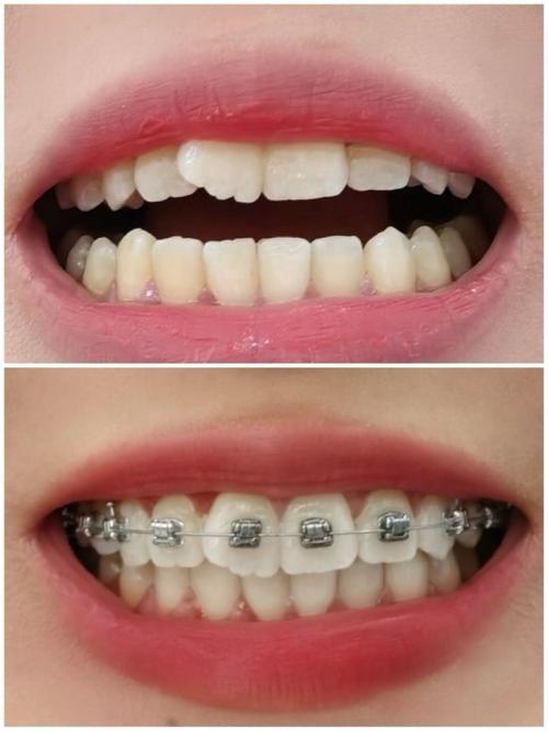 26岁做牙齿矫正来得及吗？年龄大会不会影响效果和矫正周期？-图2