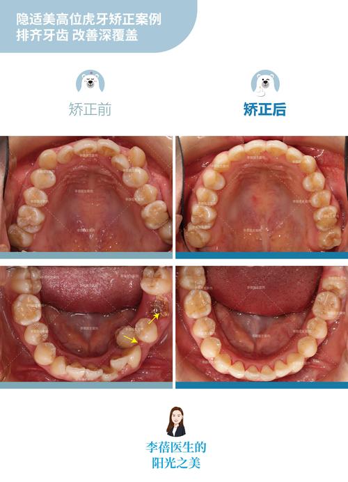 广州 牙齿矫正 便宜-图2