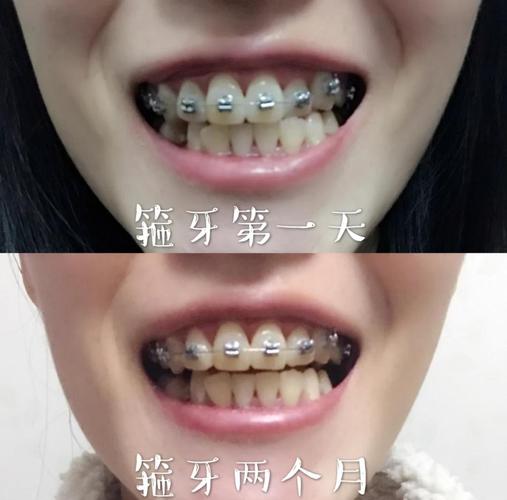 26岁矫正牙齿还来得及吗？成年人矫正有年龄限制吗？-图2