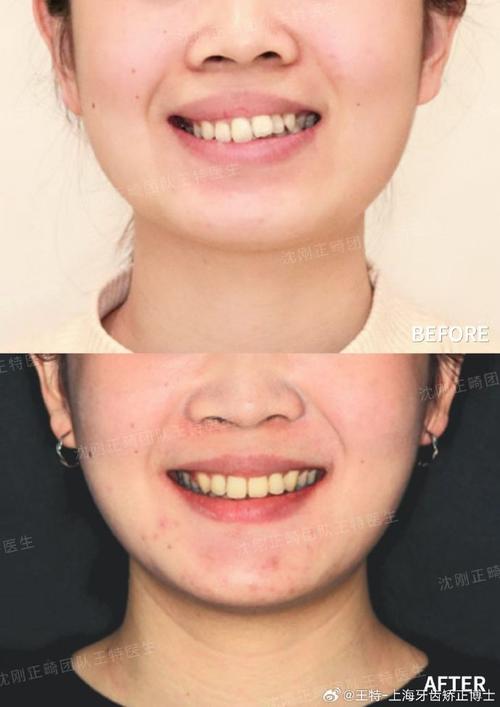 23岁还能矫正牙齿吗-图1