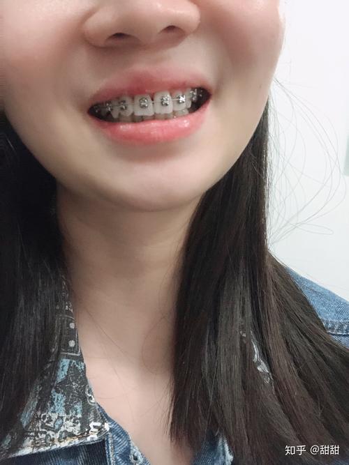 武汉大学口腔矫正牙齿效果怎么样？-图3