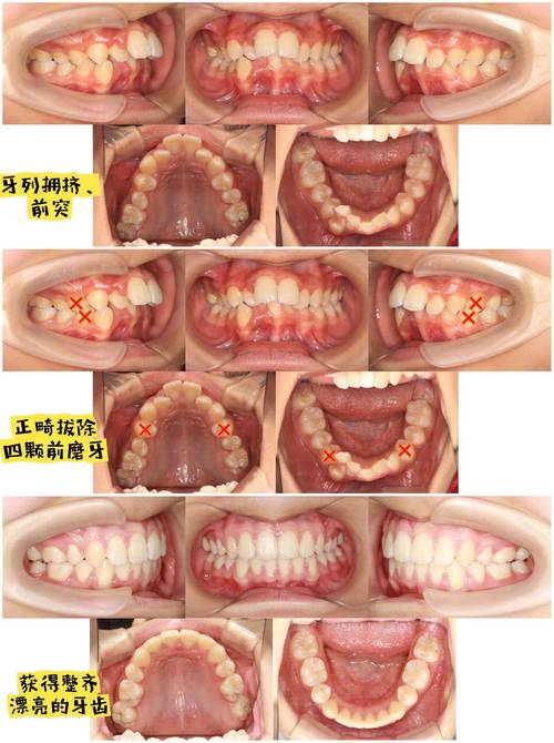 矫正牙齿，拔牙是必须的吗？-图1