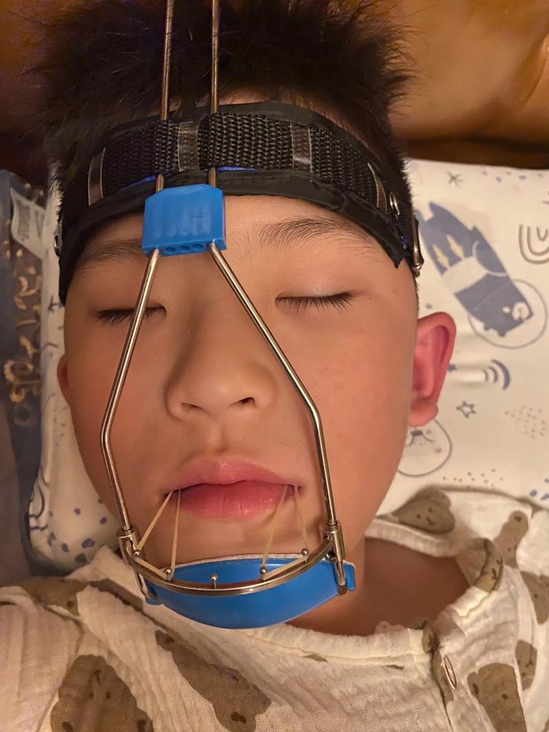 矫正牙齿牙套怎么戴?详细步骤与注意事项全解析-图2 矫正牙齿牙套怎么戴?详细步骤与注意事项全解析-图2