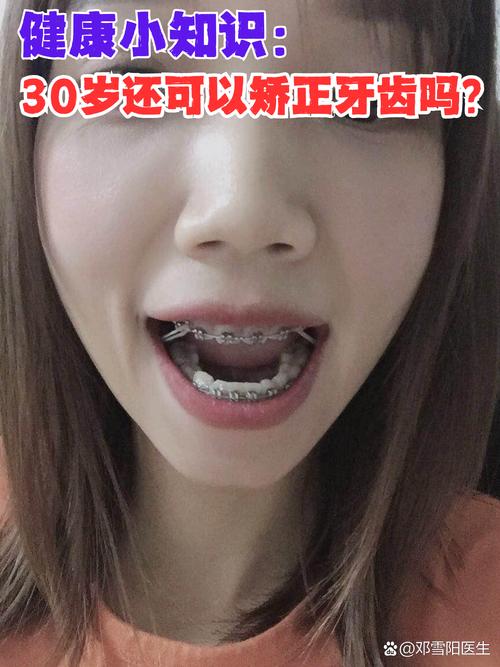 30岁矫正牙齿还来得及吗？会不会太晚效果打折扣？-图1
