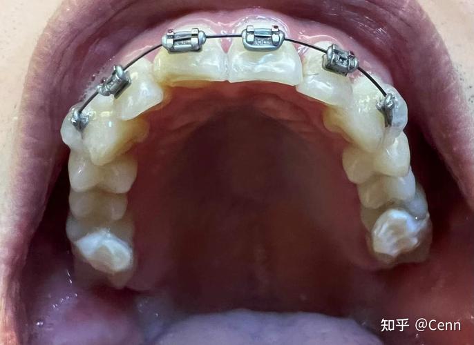 徐汇牙防所牙齿矫正效果如何？值得信赖吗？-图1