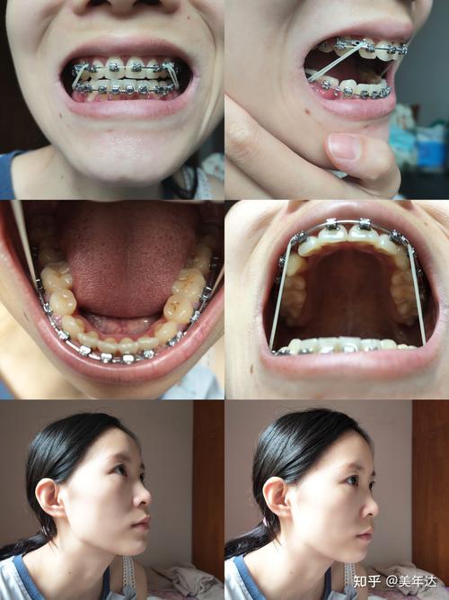 矫正牙齿对怀孕有影响吗？孕期矫正需注意哪些安全问题？-图2