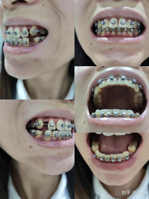 矫正牙齿对怀孕有影响吗？孕期矫正需注意哪些安全问题？-图3