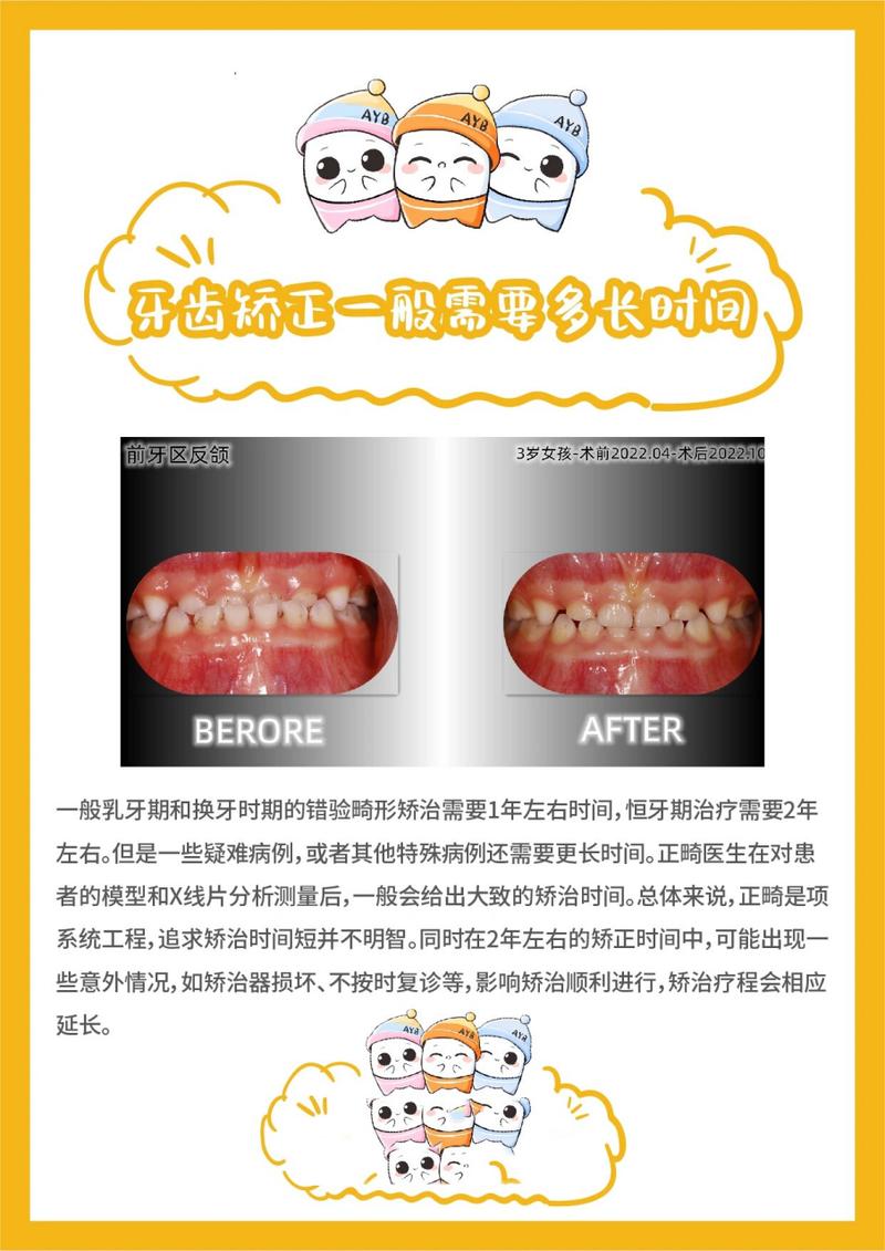 牙齿矫正的时间是多久-图3 牙齿矫正的时间是多久-图3