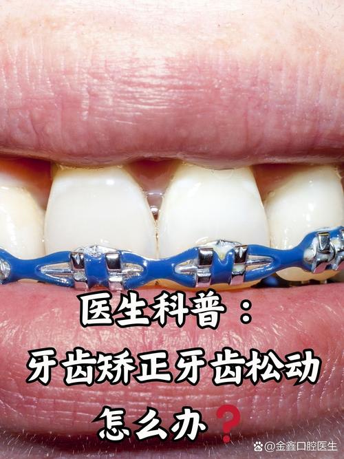 26了可以矫正牙齿吗-图2 26了可以矫正牙齿吗-图2