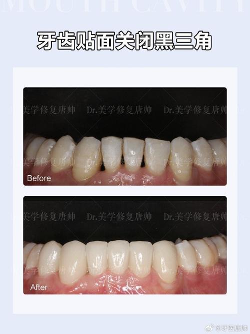 矫正牙齿 牙齿是黑的-图3 矫正牙齿 牙齿是黑的-图3