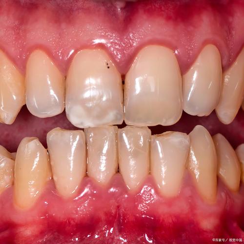 牙齿矫正后 牙齿松动-图1 牙齿矫正后 牙齿松动-图1