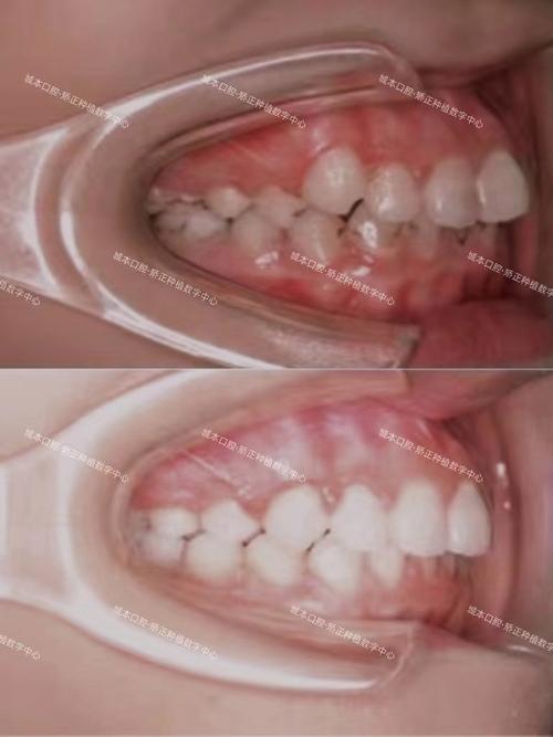 矫正拔牙后，牙齿的移动和最终排列会受影响吗？-图1