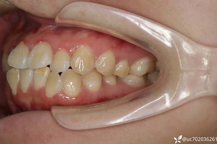 矫正拔牙后，牙齿的移动和最终排列会受影响吗？-图2