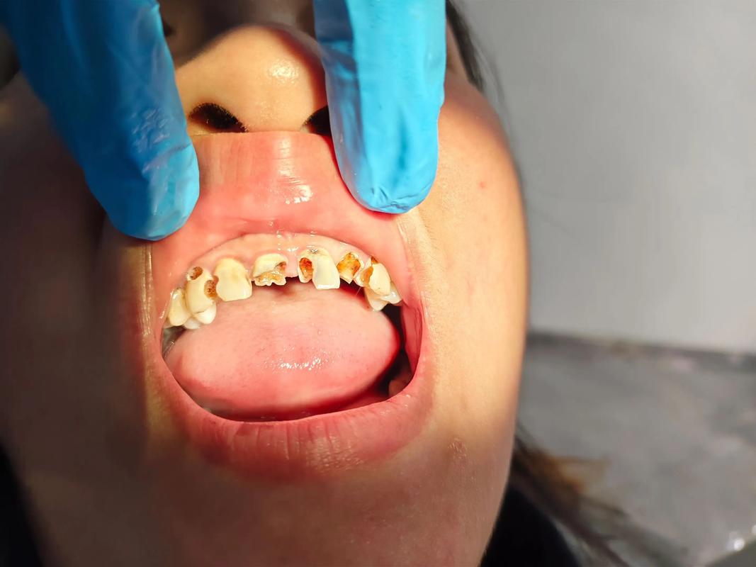 根管治疗后能矫正牙齿吗？时机要注意什么？-图2