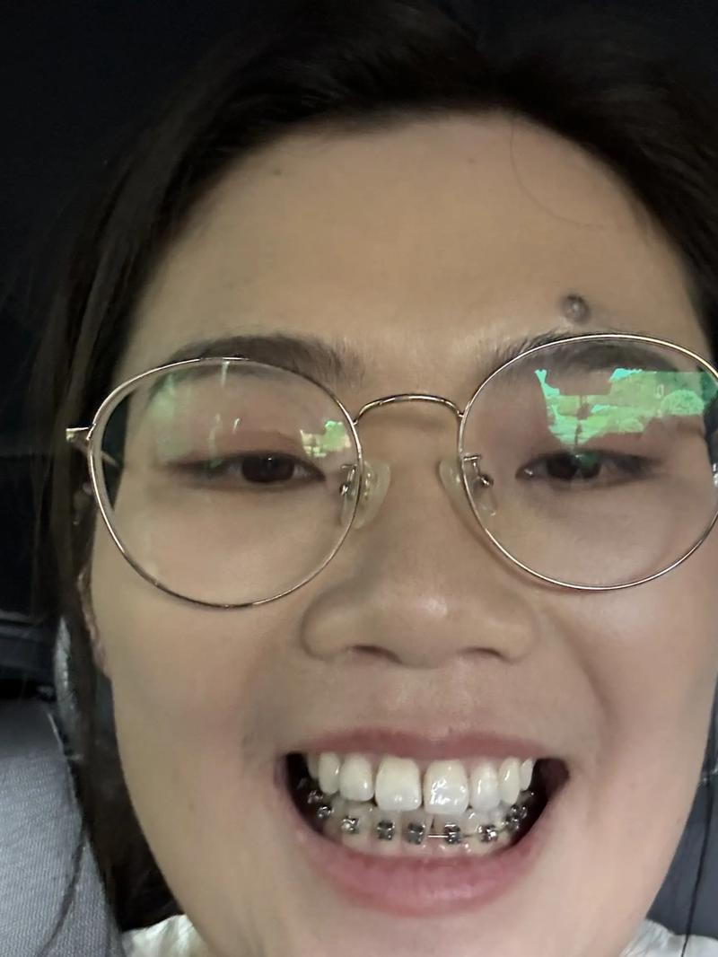 矫正牙齿会牙根吸收吗-图2