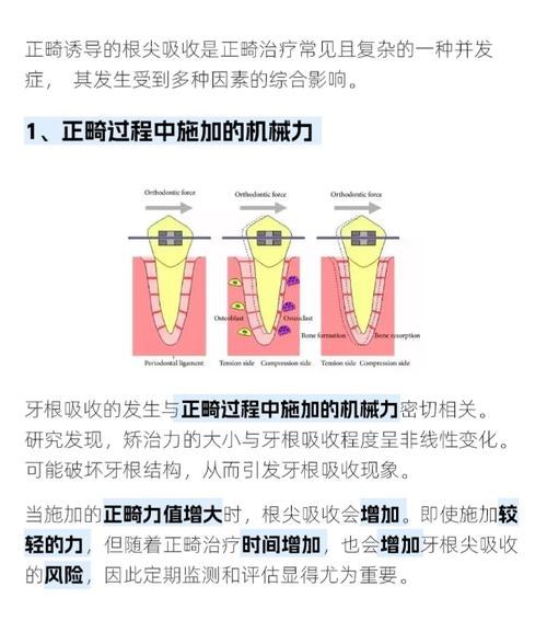 牙齿矫正会不会导致牙根吸收？-图1