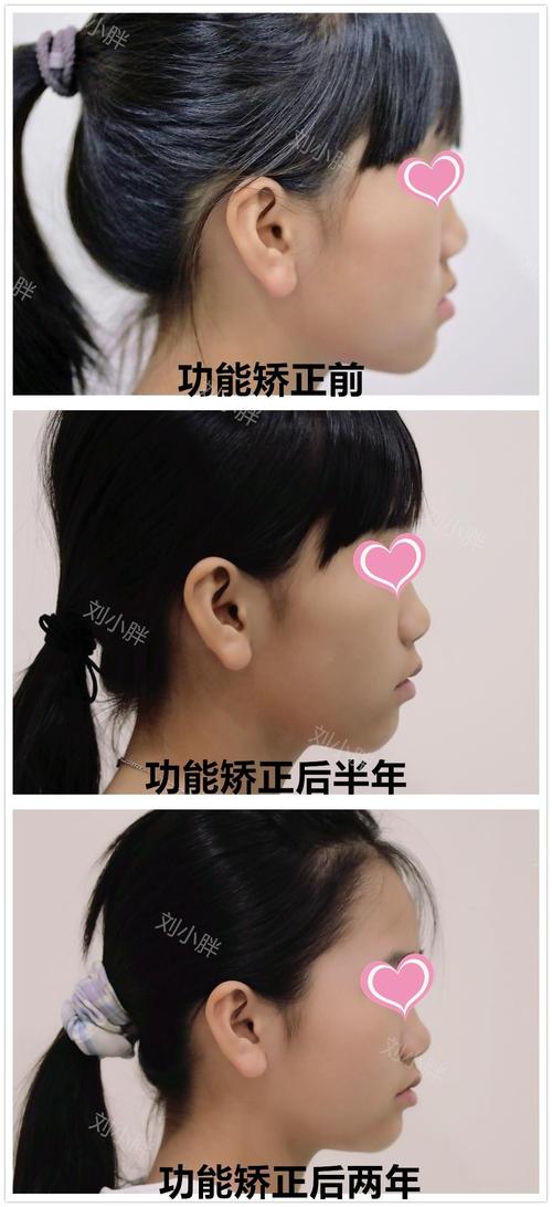 儿童MRC牙齿矫正器效果怎么样？几岁戴最合适？需注意什么？-图2