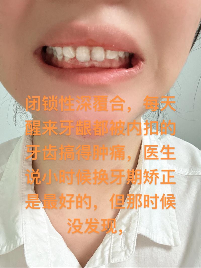 22岁矫正牙齿,这些危害真的存在吗?-图1 22岁矫正牙齿,这些危害真的存在吗?-图1