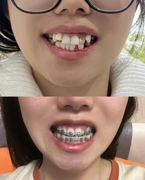 上海牙齿矫正哪家医院好？求推荐！-图1