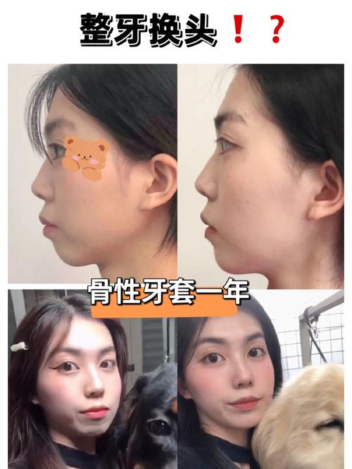 牙齿矫正前后侧面对比照片，能直观看出哪些面部改善？-图1