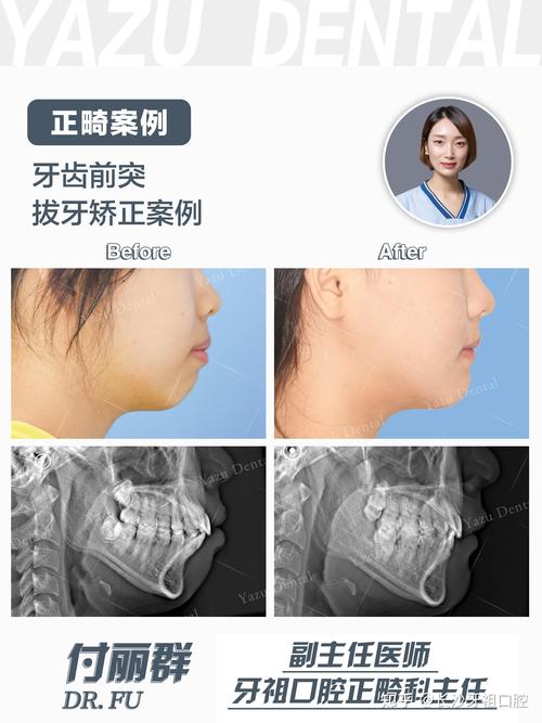 矫正牙齿能只做上牙吗？-图2
