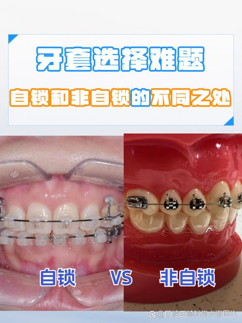 牙齿矫正自锁托槽图片-图1