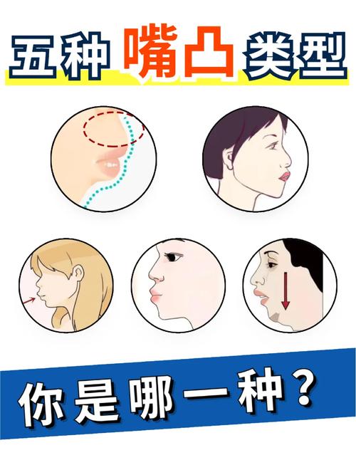 矫正牙齿能改变凸嘴吗？效果如何？-图1