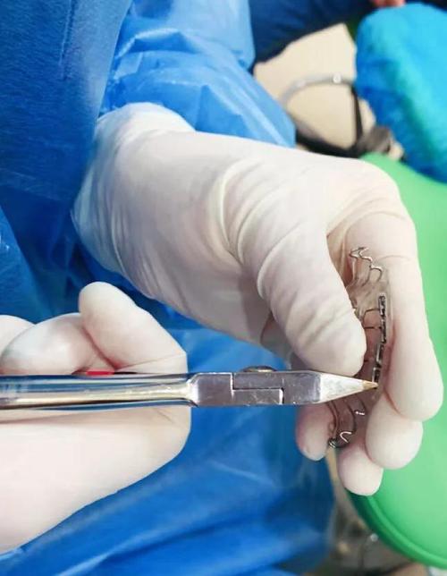 矫正牙齿手术过程视频能真实展现细节吗？-图1