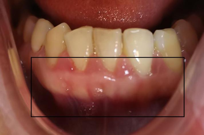 矫正牙齿牙龈增生图片-图3