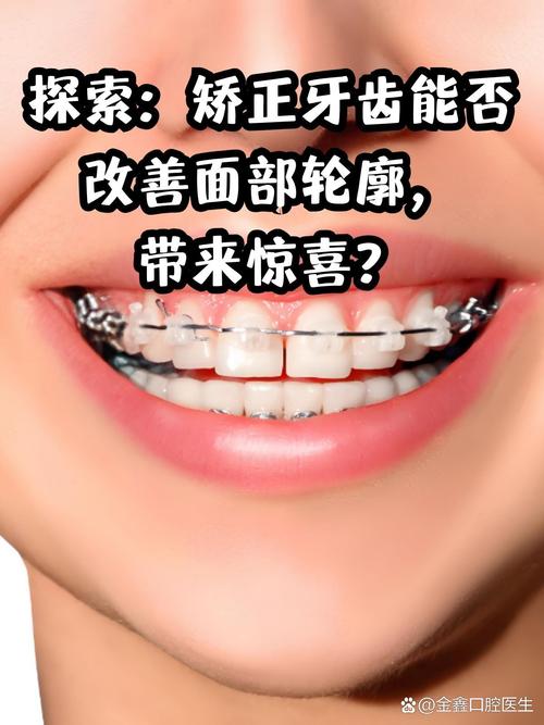 矫正牙齿会影响脸型吗-图2
