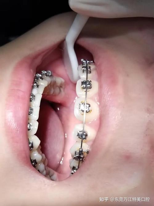 东莞牙齿矫正哪家正规？选靠谱机构要看资质、口碑和服务！-图2
