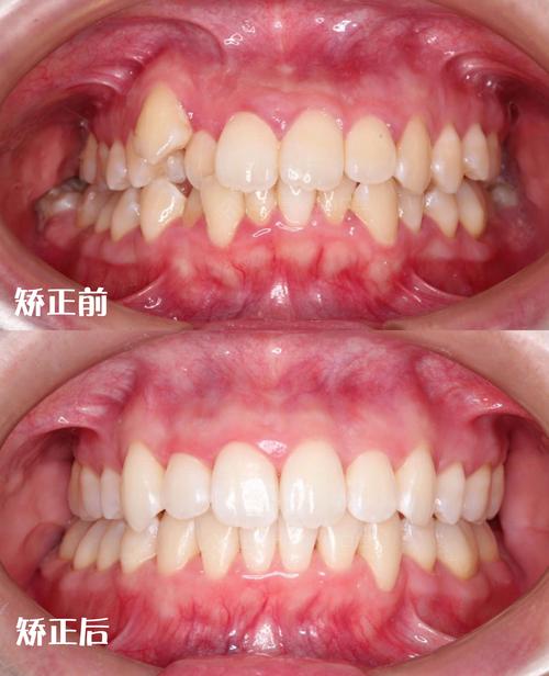 牙齿开合矫正前后图片-图3