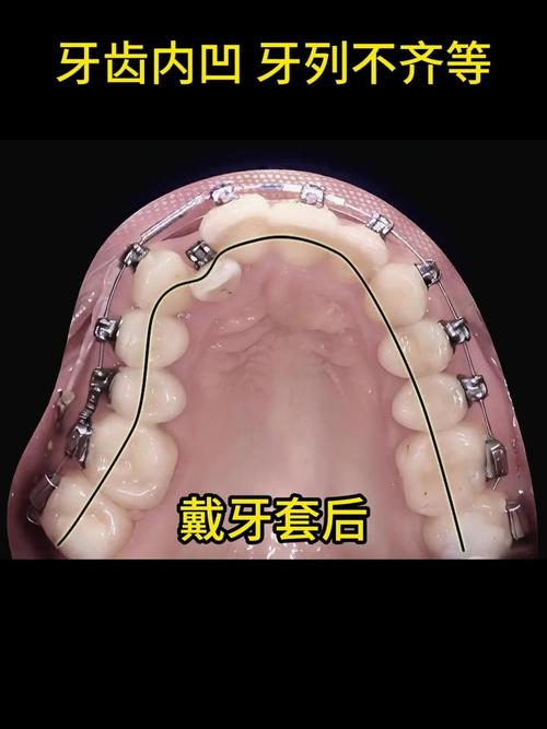 牙齿内凹也能矫正吗？矫正方法有哪些？效果如何？-图3