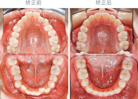 30岁矫正牙齿，真的会留下不可逆的后遗症吗？-图2