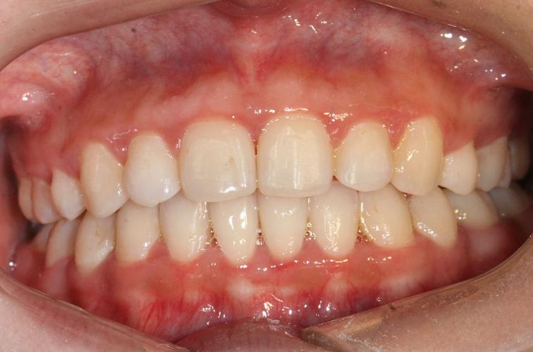 牙齿矫正后牙龈萎缩图，为何会出现牙龈萎缩？-图1